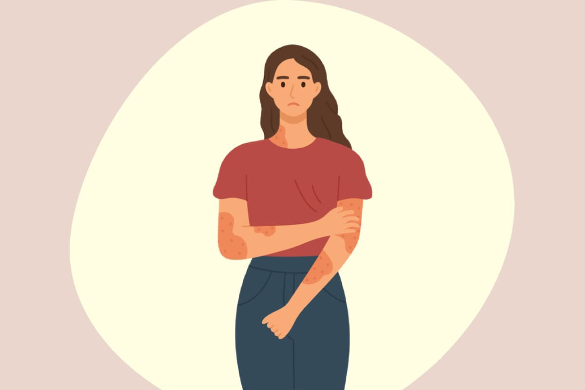 psoriasis:-learn-about-the-symptoms-of-the-disease-and-factors-that-can-trigger-attacks